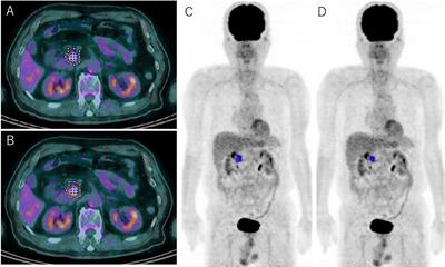 Defining the Optimal Method for Measuring Metabolic Tumor Volume on Preoperative 18F-Fluorodeoxyglucose-Positron Emission Tomography/Computed Tomography as a Prognostic Predictor in Patients With Pancreatic Ductal Adenocarcinoma